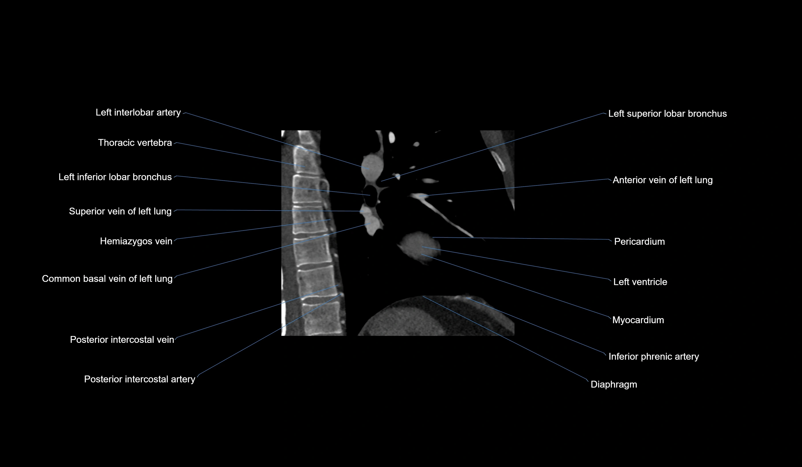 CT heart (coronary angiogram) 2 chamber view cross sectional anatomy labelled radiology image-00003.webp